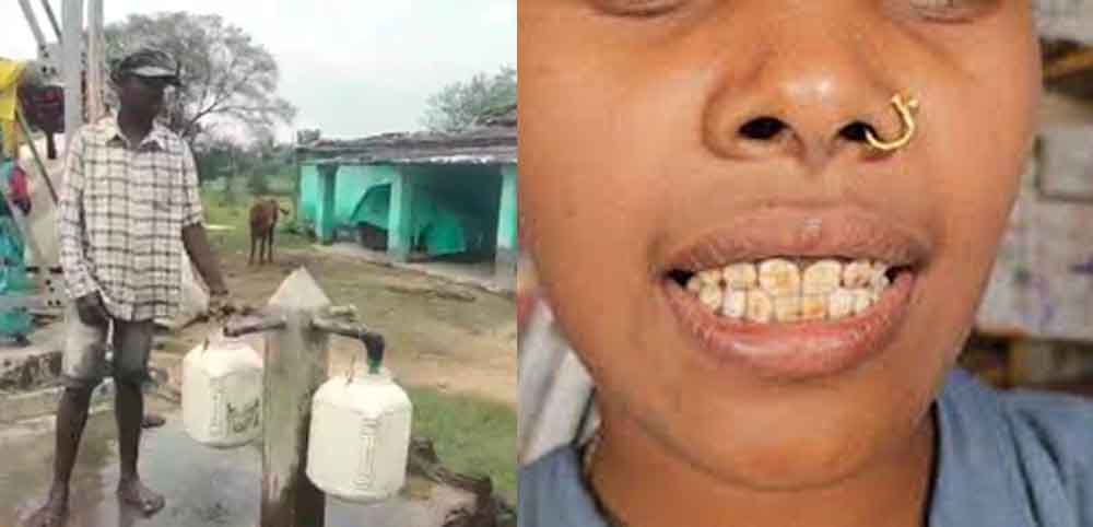 छत्तीसगढ़-गरियाबंद में फ्लोराइड युक्त पानी पर मांगा जवाब, हाईकोर्ट ने पीएचई विभाग से मांगा शपथ पत्र छत्तीसगढ़-गरियाबंद में फ्लोराइड युक्त पानी पर मांगा जवाब, हाईकोर्ट ने पीएचई विभाग से मांगा शपथ पत्र