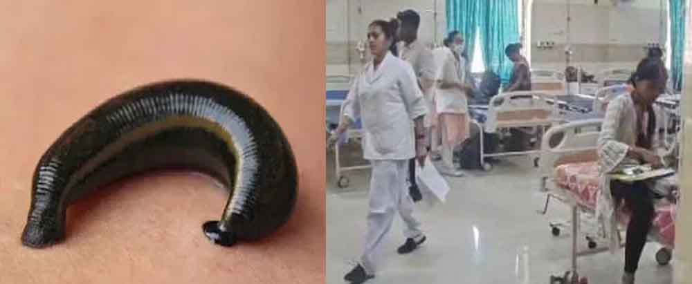 छत्तीसगढ़-कोरबा में चार साल की बच्ची के गुप्तांग में घुसी जोंक, डॉक्टरों ने सूझबूझ से निकाली बाहर
