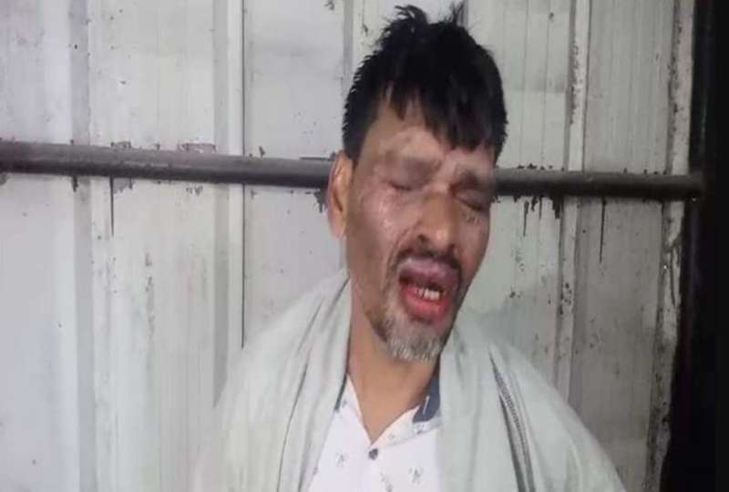 पत्नी ने पति पर किया एसिड अटैक, छः साल से विवाद के बावजूद रह रहे थे साथ साथ 