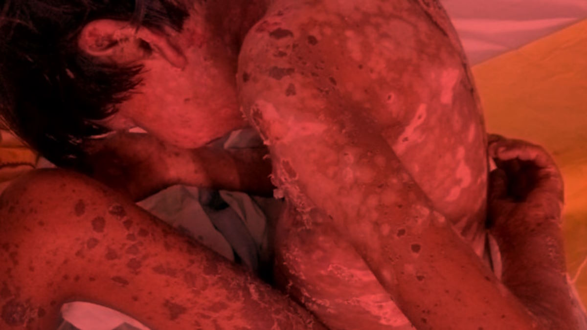 CG- स्वास्थ्य व्यवस्था पर उठे सवाल: टीकाकरण के बाद मासूम को गंभीर रिएक्शन, पूरे शरीर में हुए फोड़े, परिजनों की शिकायत पर जांच समिति गठित… CG- स्वास्थ्य व्यवस्था पर उठे सवाल: टीकाकरण के बाद मासूम को गंभीर रिएक्शन, पूरे शरीर में हुए फोड़े, परिजनों की शिकायत पर जांच समिति गठित…